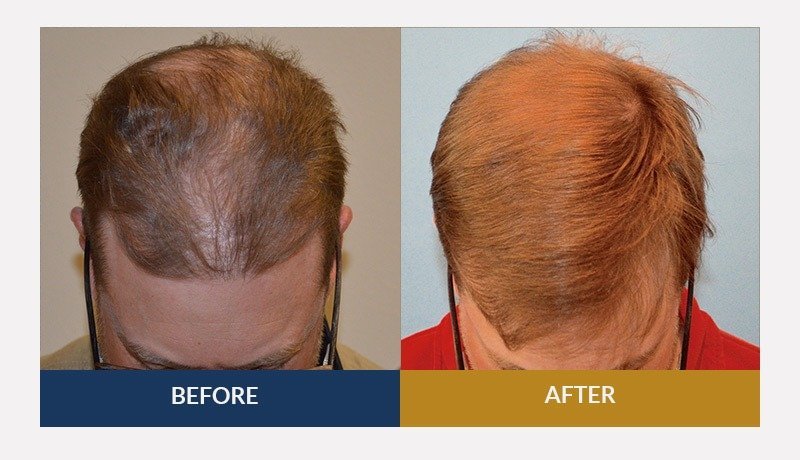 Results - The Paragon Hair Clinic
