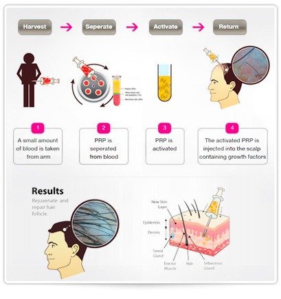 PRP: Unlocking Your Body to Regrow Hair - The Paragon Hair Clinic
